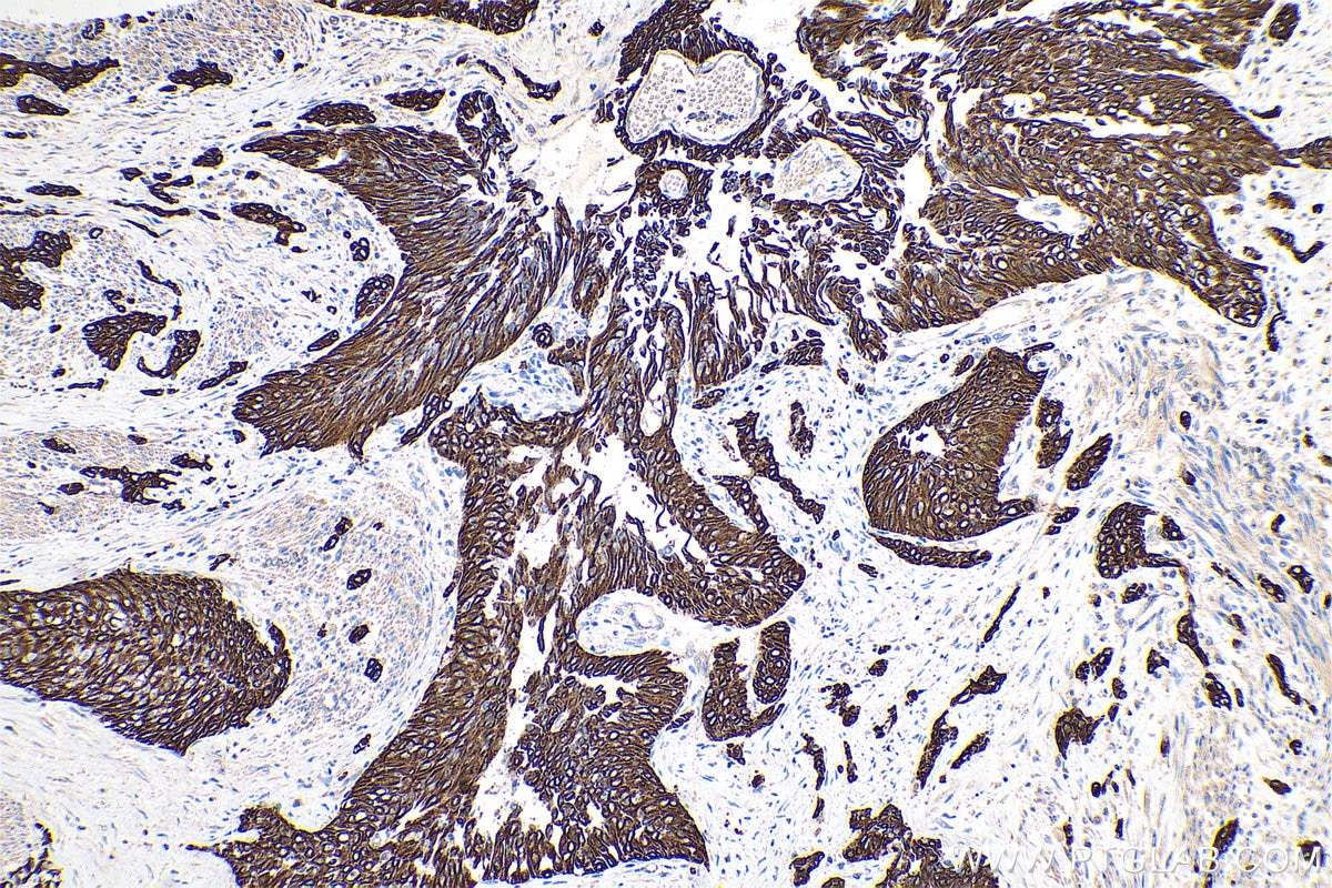 Immunohistochemical analysis of paraffin-embedded human urothelial carcinoma tissue slide using KHC0754 (KRT33B IHC Kit).