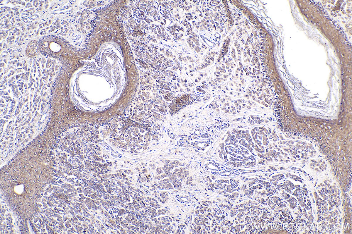 Immunohistochemical analysis of paraffin-embedded human malignant melanoma tissue slide using KHC0755 (KRT34 IHC Kit).