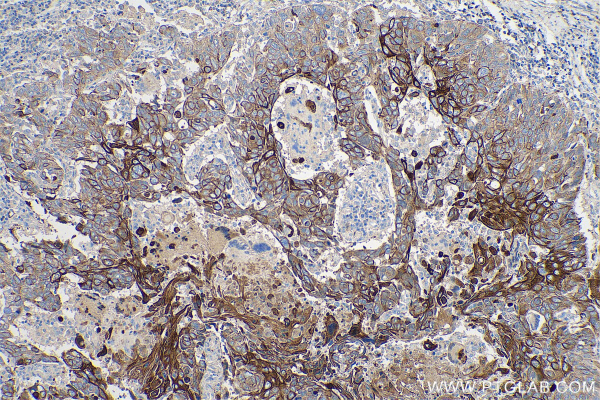 Immunohistochemical analysis of paraffin-embedded human lung cancer tissue slide using KHC0746 (KRT5/6 IHC Kit).