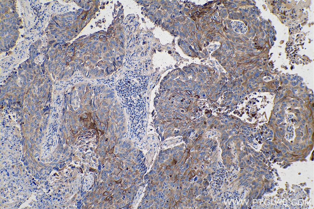 Immunohistochemical analysis of paraffin-embedded human lung cancer tissue slide using KHC0747 (KRT6 IHC Kit).
