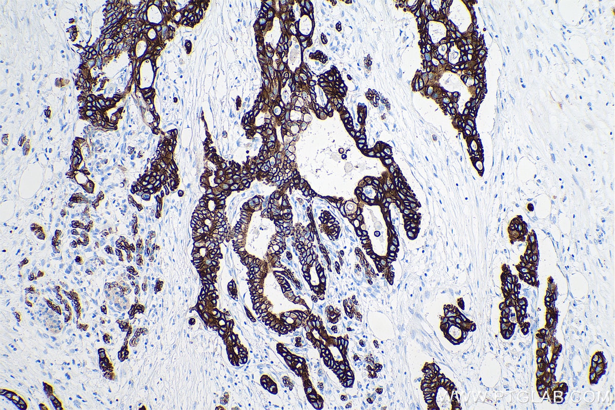 Immunohistochemical analysis of paraffin-embedded human pancreas cancer tissue slide using KHC0748 (KRT7/CK7 IHC Kit).
