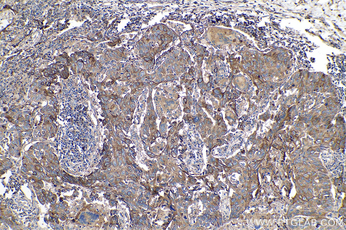 Immunohistochemical analysis of paraffin-embedded human lung cancer tissue slide using KHC0756 (KRT81 IHC Kit).