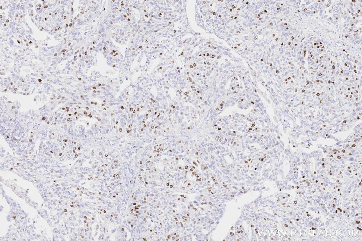 Immunohistochemical analysis of paraffin-embedded human ovary cancer tissue slide using KHC3316 (Ki-67 IHC Kit). Immunohistochemical analysis of paraffin-embedded human ovary cancer tissue slide using KHC3316 (Ki-67 IHC Kit).