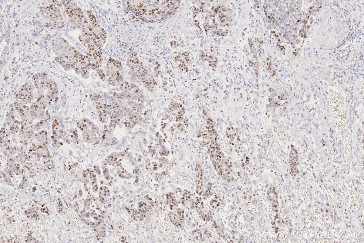 Immunohistochemical analysis of paraffin-embedded human stomach cancer tissue slide using KHC3316 (Ki-67 IHC Kit). Immunohistochemical analysis of paraffin-embedded human stomach cancer tissue slide using KHC3316 (Ki-67 IHC Kit).