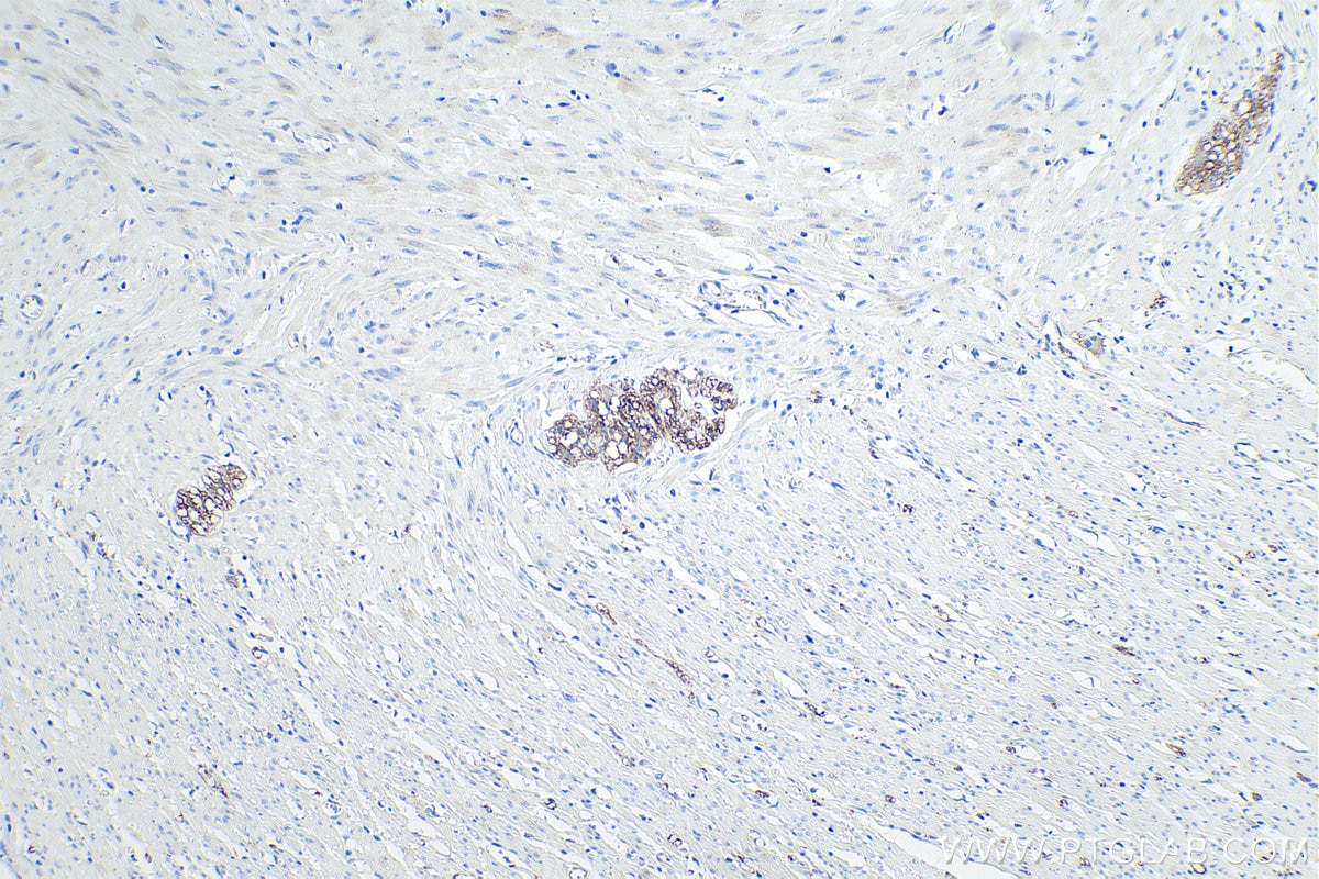 Immunohistochemical analysis of paraffin-embedded human colon tissue slide using KHC0112 (L1CAM IHC Kit).