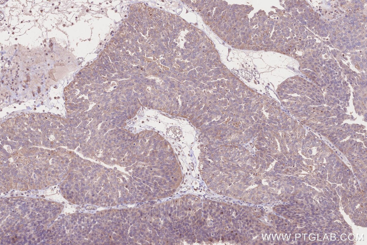 Immunohistochemical analysis of paraffin-embedded human ovary cancer tissue slide using KHC2644 (LACC1 IHC Kit).