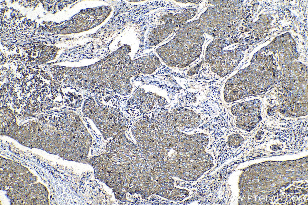 Immunohistochemical analysis of paraffin-embedded human lung cancer tissue slide using KHC1336 (LAMP1/CD107a IHC Kit).