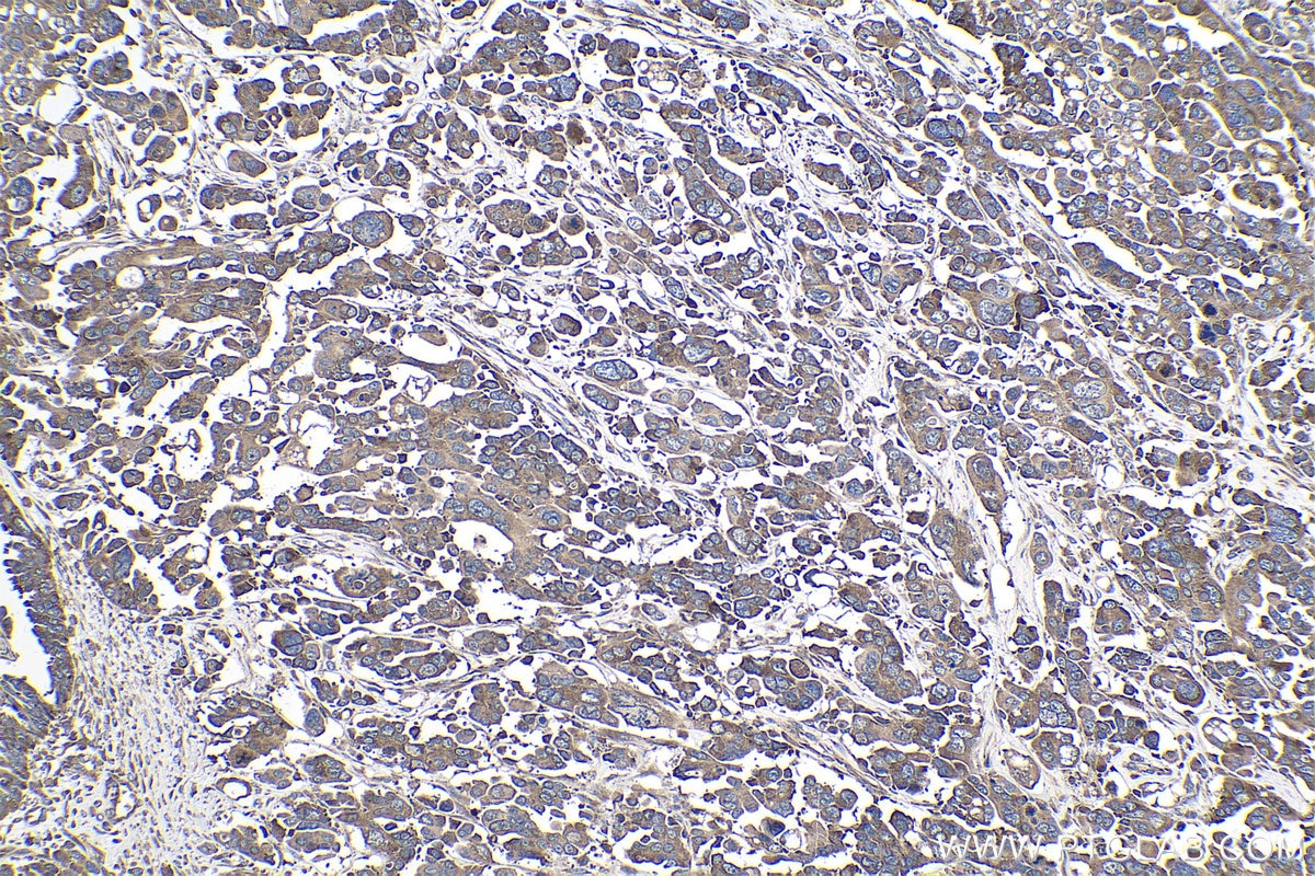 Immunohistochemical analysis of paraffin-embedded human colon cancer tissue slide using KHC1005 (LARP1 IHC Kit).