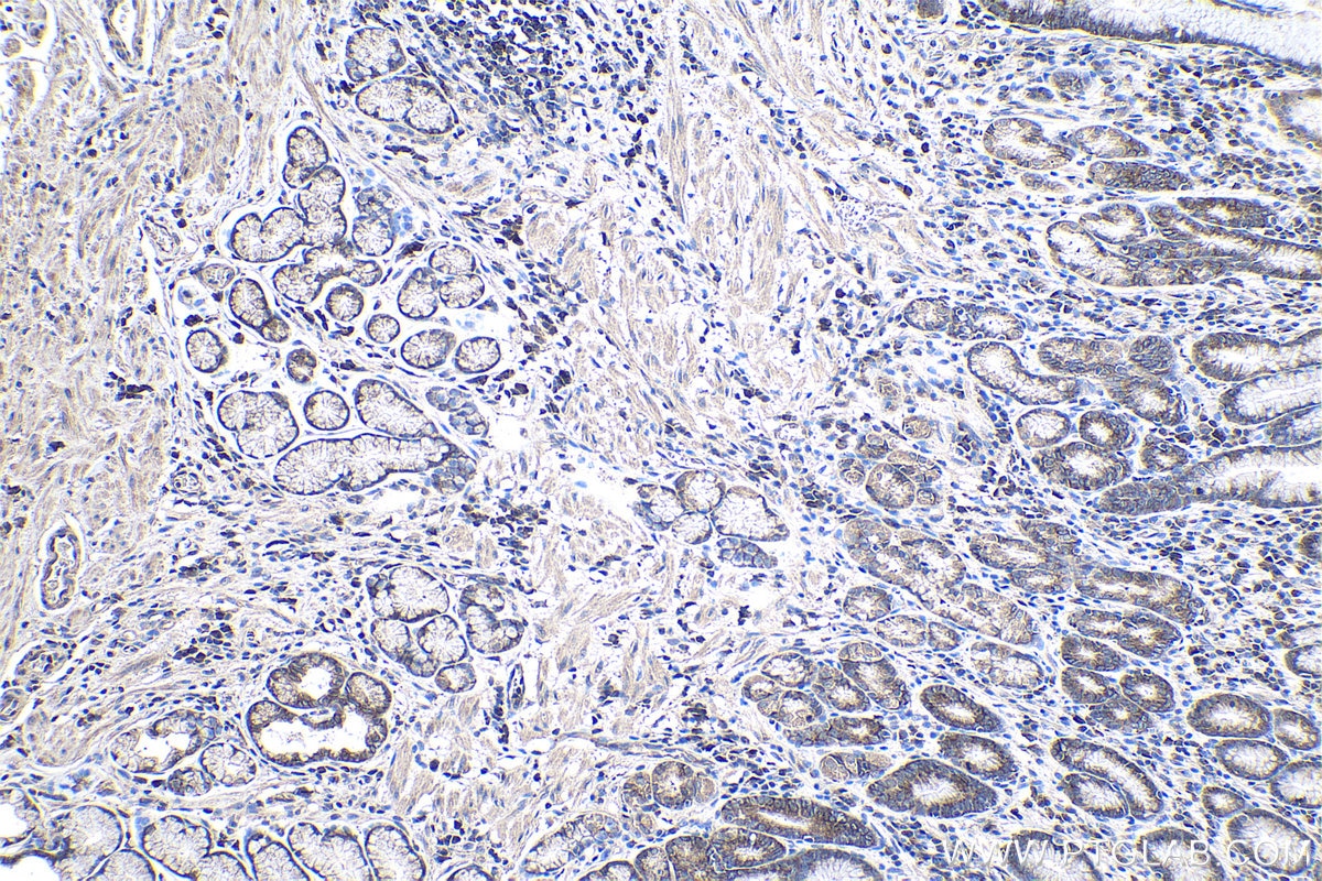 Immunohistochemical analysis of paraffin-embedded human stomach cancer tissue slide using KHC1005 (LARP1 IHC Kit).