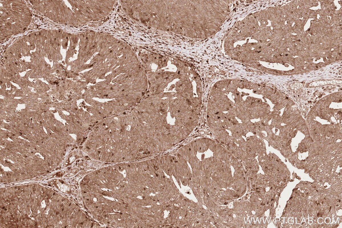 Immunohistochemical analysis of paraffin-embedded human ovary cancer tissue slide using KHC2609 (LARP4 IHC Kit).