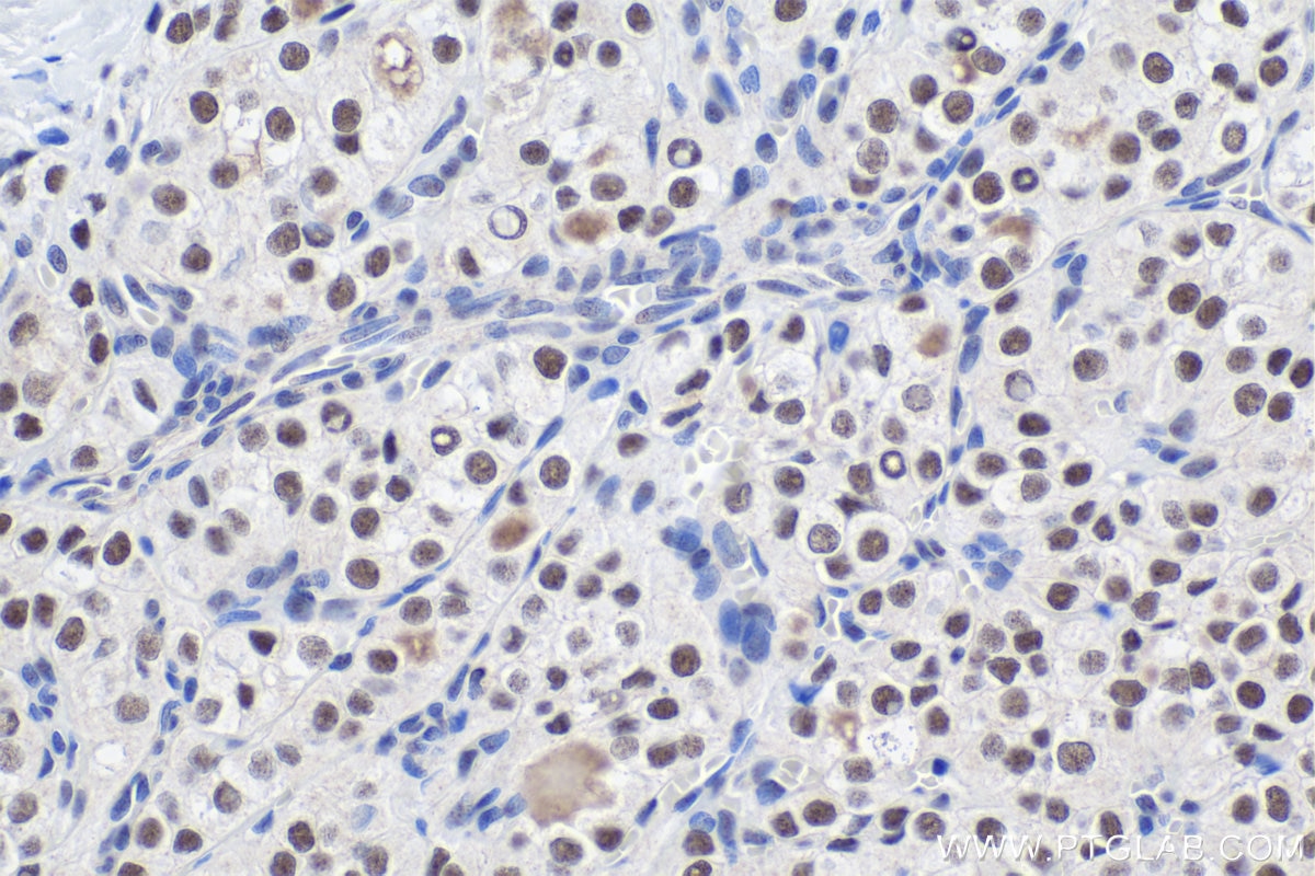 Immunohistochemical analysis of paraffin-embedded human thyroid cancer tissue slide using KHC1771 (LARP7 IHC Kit).