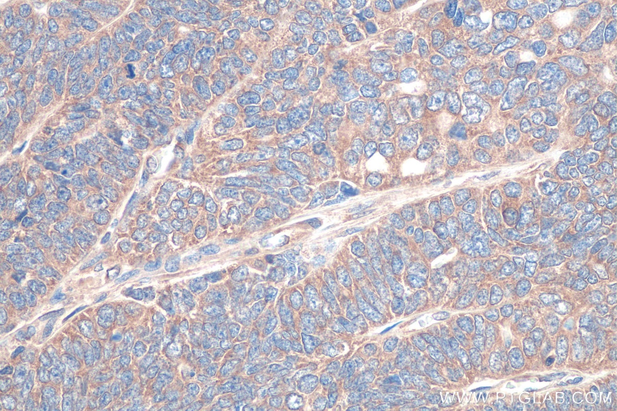 Immunohistochemical analysis of paraffin-embedded human ovary tumor tissue slide using KHC0866 (LARS1 IHC Kit).