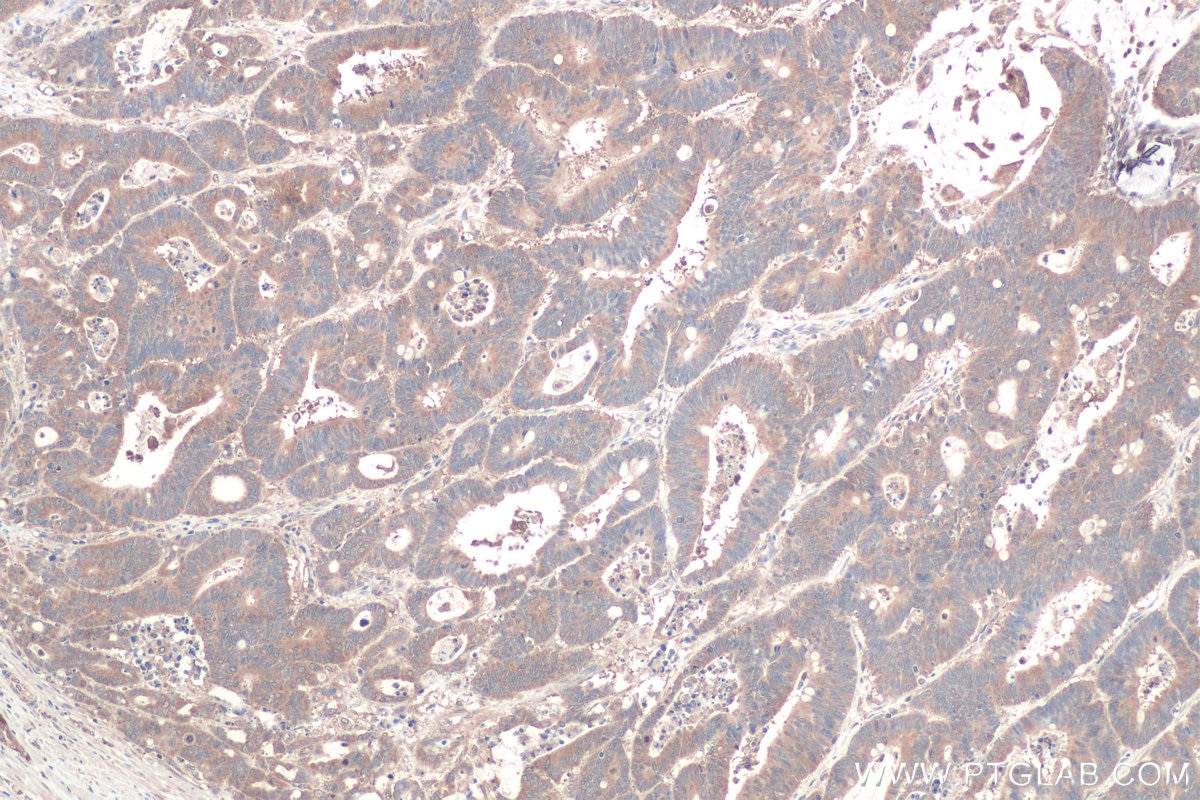 Immunohistochemical analysis of paraffin-embedded human colon cancer tissue slide using KHC0866 (LARS1 IHC Kit).