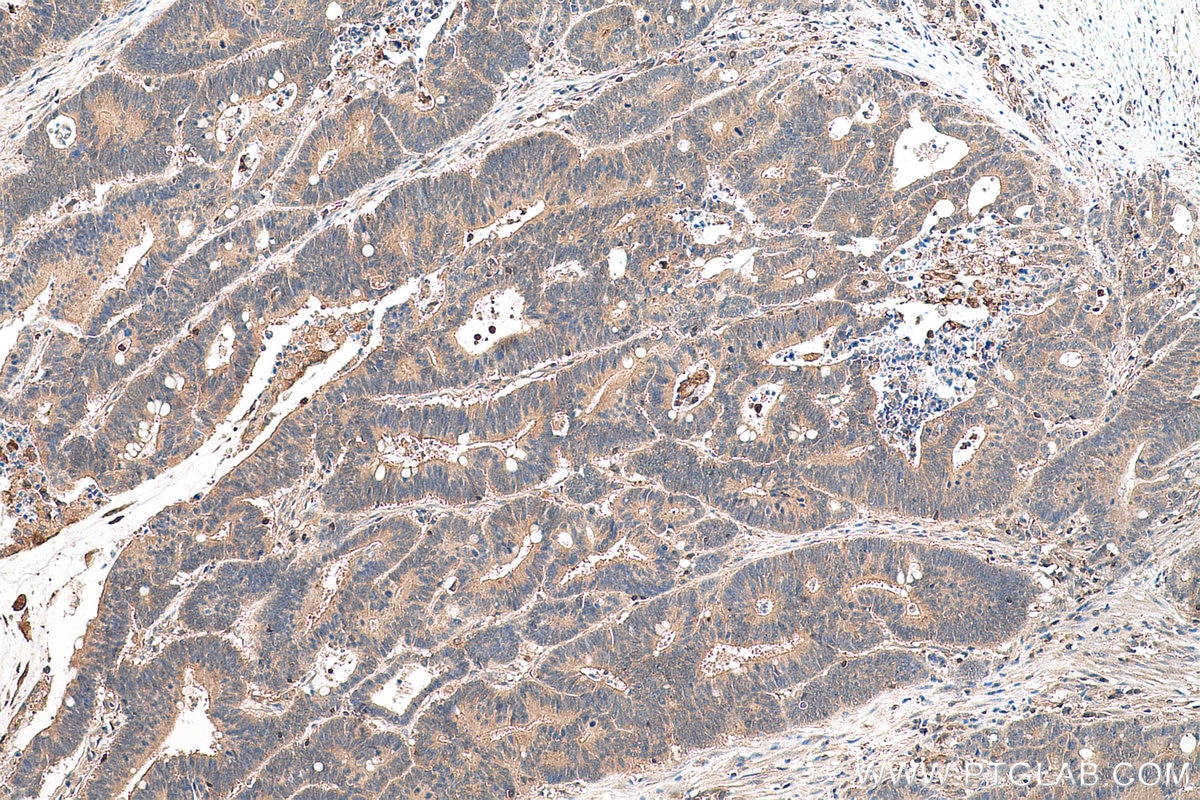Immunohistochemical analysis of paraffin-embedded human colon cancer tissue slide using KHC0676 (LASP1 IHC Kit).