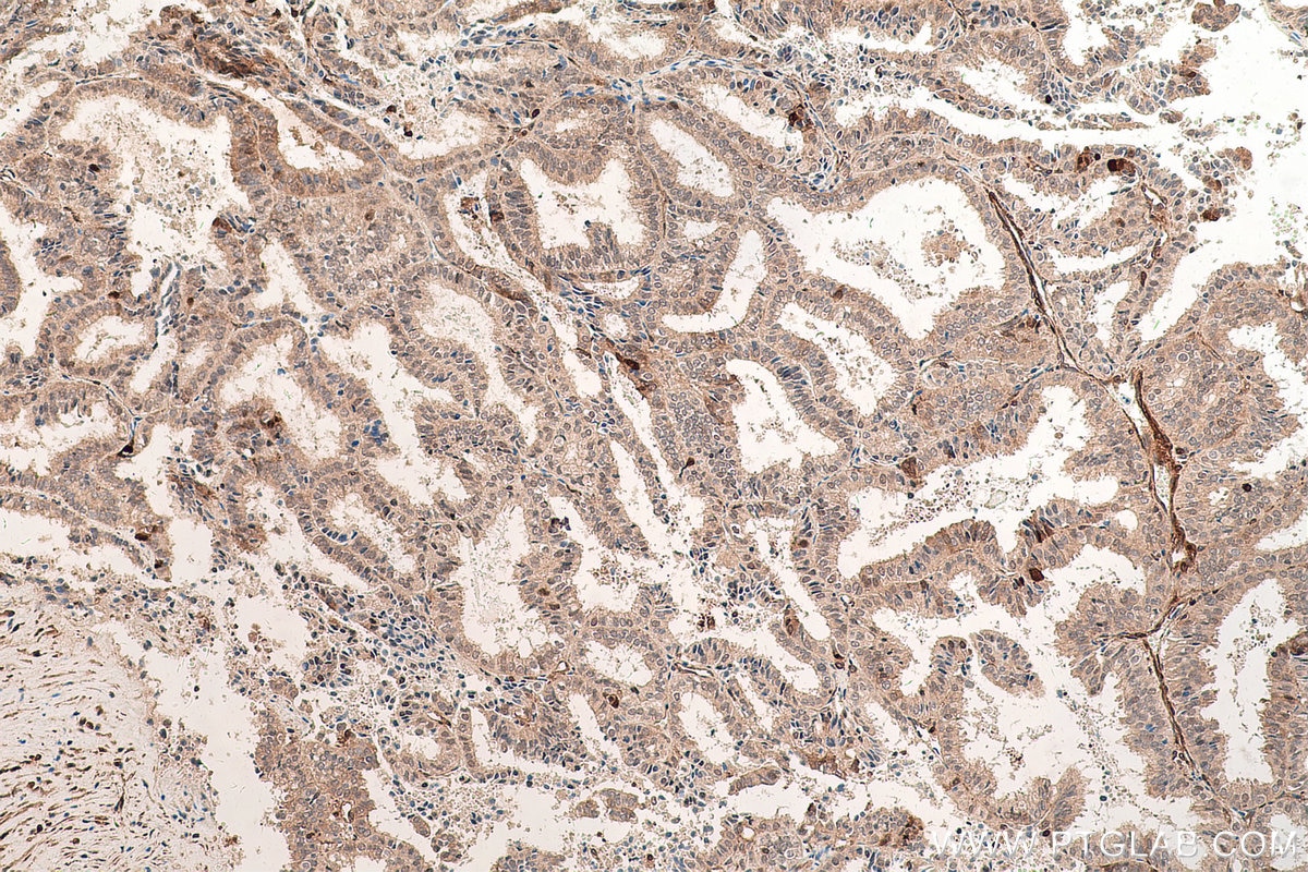 Immunohistochemical analysis of paraffin-embedded human ovary tumor tissue slide using KHC0676 (LASP1 IHC Kit).