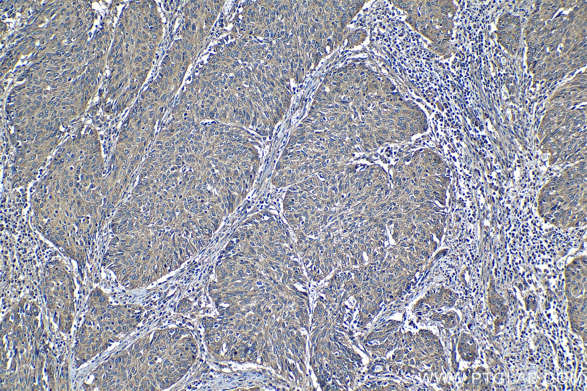 Immunohistochemical analysis of paraffin-embedded human cervical cancer tissue slide using KHC1245 (LATS2 IHC Kit).