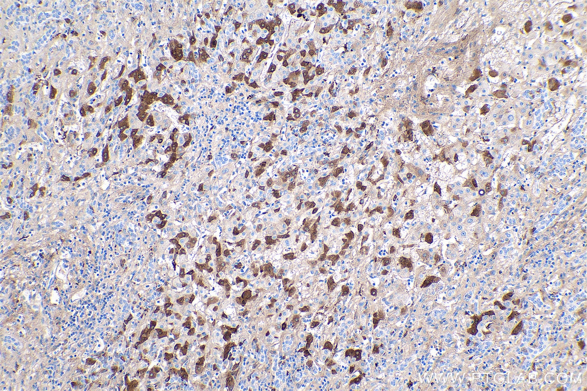 Immunohistochemical analysis of paraffin-embedded human liver cancer tissue slide using KHC0432 (LBP IHC Kit).