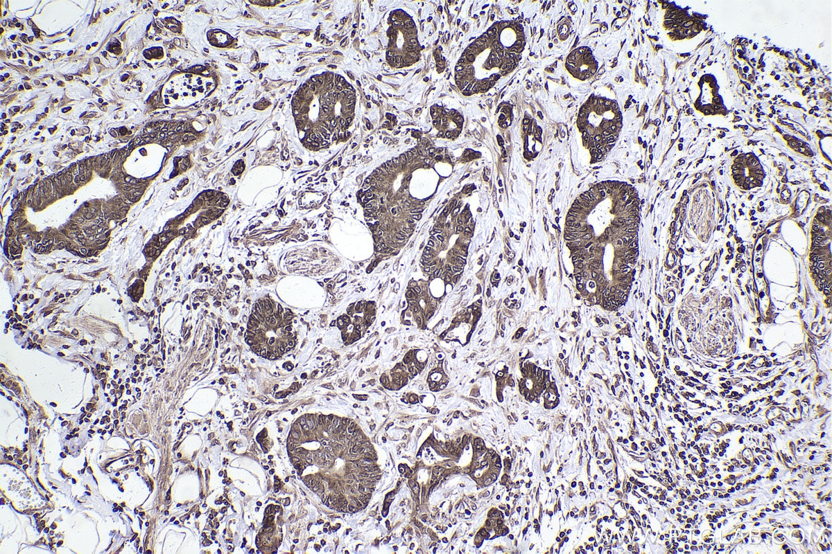 Immunohistochemical analysis of paraffin-embedded human rectal cancer tissue slide using KHC2467 (LBR IHC Kit).