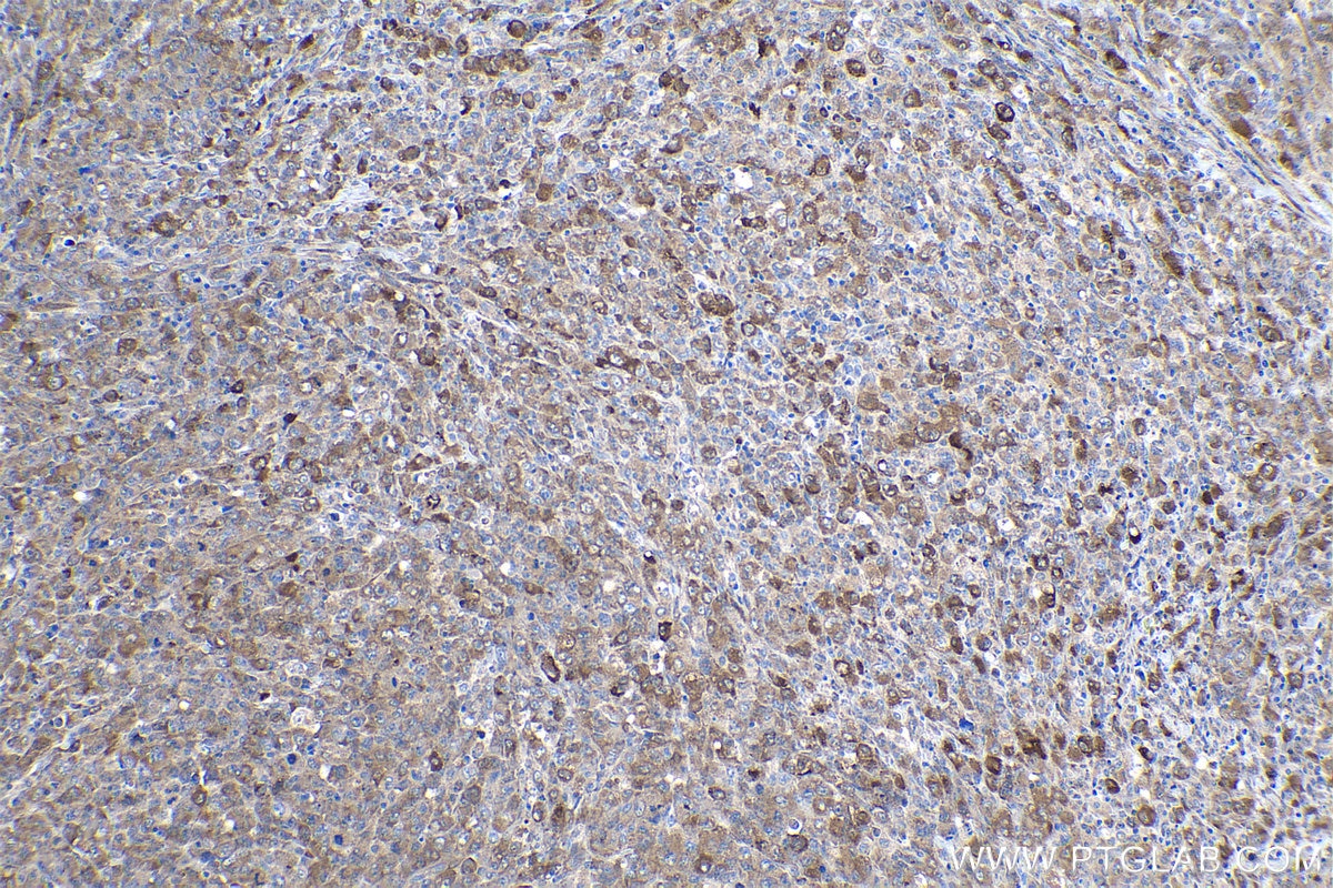 Immunohistochemical analysis of paraffin-embedded human lymphoma tissue slide using KHC0940 (LC3 IHC Kit).