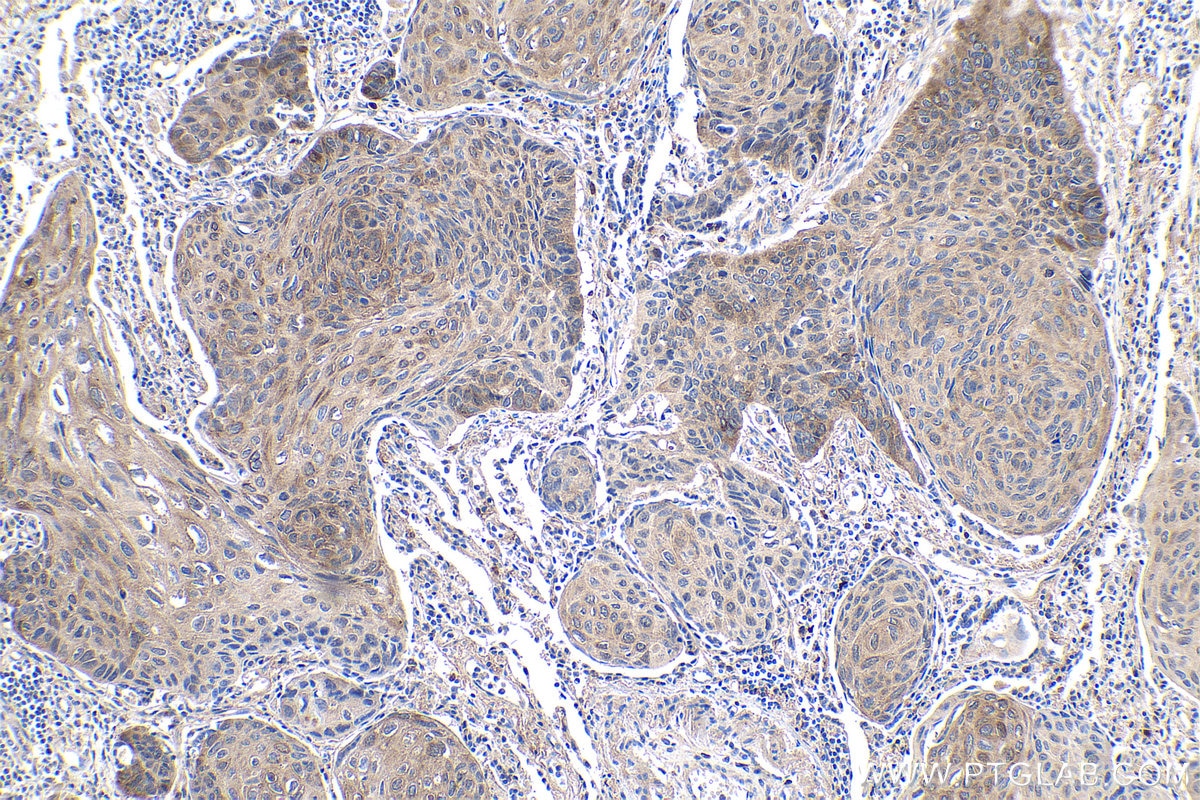Immunohistochemical analysis of paraffin-embedded human lung cancer tissue slide using KHC0940 (LC3 IHC Kit).