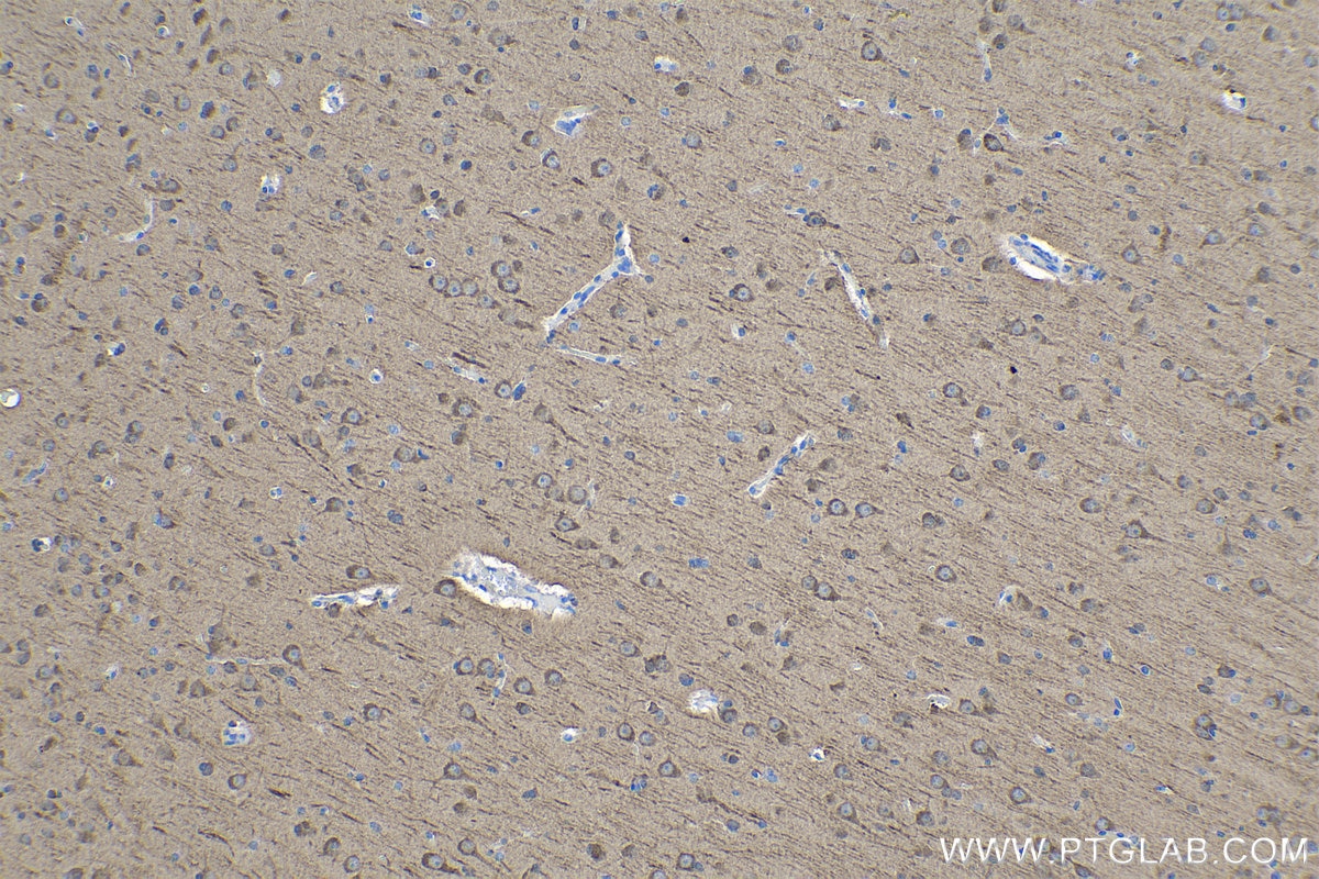 Immunohistochemical analysis of paraffin-embedded human gliomas tissue slide using KHC0940 (LC3 IHC Kit).