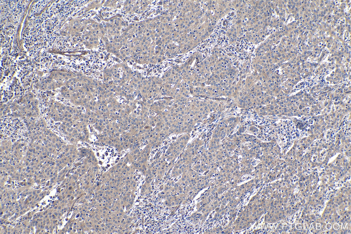 Immunohistochemical analysis of paraffin-embedded human cervical cancer tissue slide using KHC0939 (LC3A/B IHC Kit).