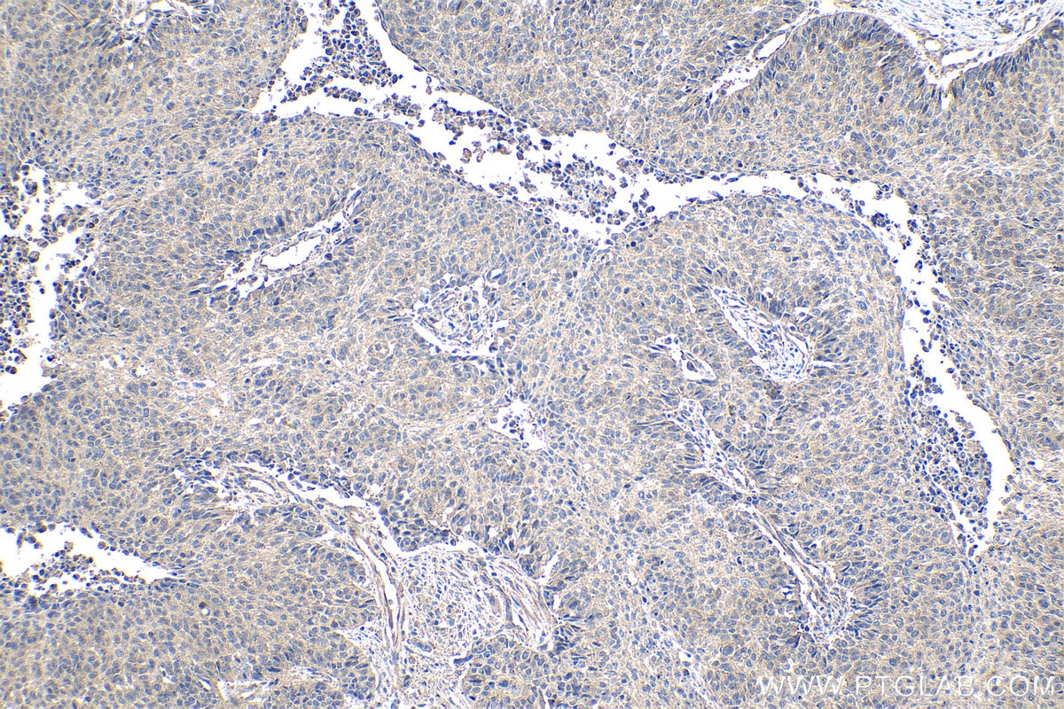 Immunohistochemical analysis of paraffin-embedded human lung cancer tissue slide using KHC0939 (LC3A/B IHC Kit).