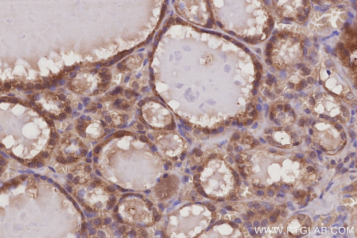 Immunohistochemical analysis of paraffin-embedded human thyroid cancer tissue slide using KHC3012 (LCMT1 IHC Kit). Immunohistochemical analysis of paraffin-embedded human thyroid cancer tissue slide using KHC3012 (LCMT1 IHC Kit).