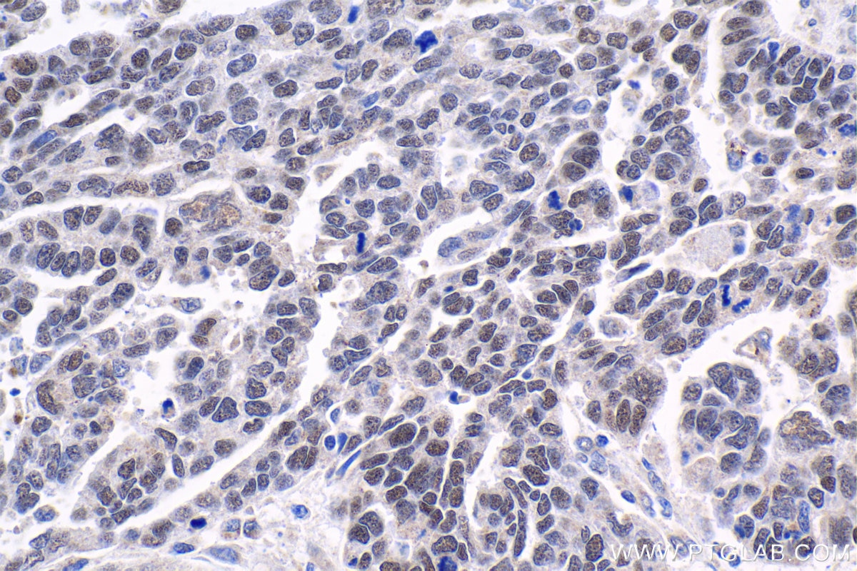 Immunohistochemical analysis of paraffin-embedded human ovary tumor tissue slide using KHC1808 (LDB1 IHC Kit).