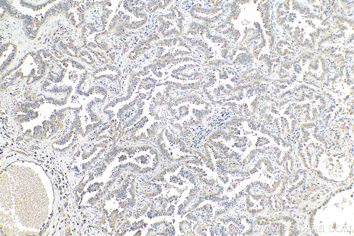 Immunohistochemical analysis of paraffin-embedded human lung cancer tissue slide using KHC0324 (LDHB IHC Kit).