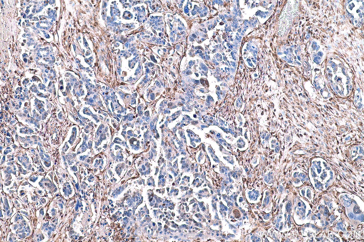 Immunohistochemical analysis of paraffin-embedded human colon cancer tissue slide using KHC0826 (LGALS1 IHC Kit).