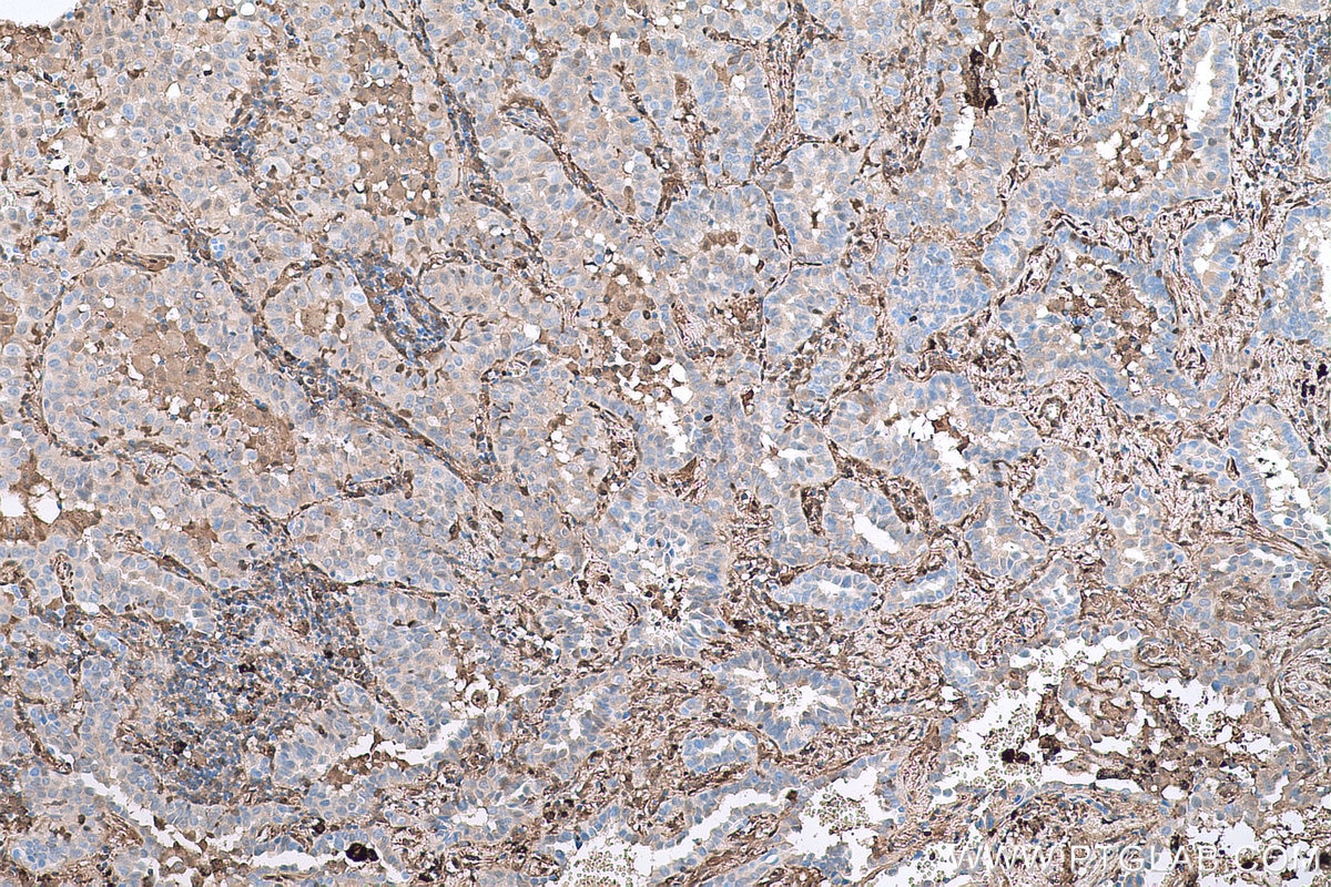 Immunohistochemical analysis of paraffin-embedded human lung cancer tissue slide using KHC0826 (LGALS1 IHC Kit).