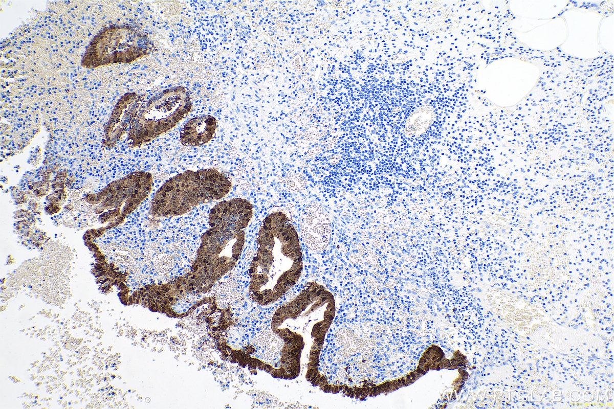 Immunohistochemical analysis of paraffin-embedded human appendicitis tissue slide using KHC0671 (LGALS4 IHC Kit).