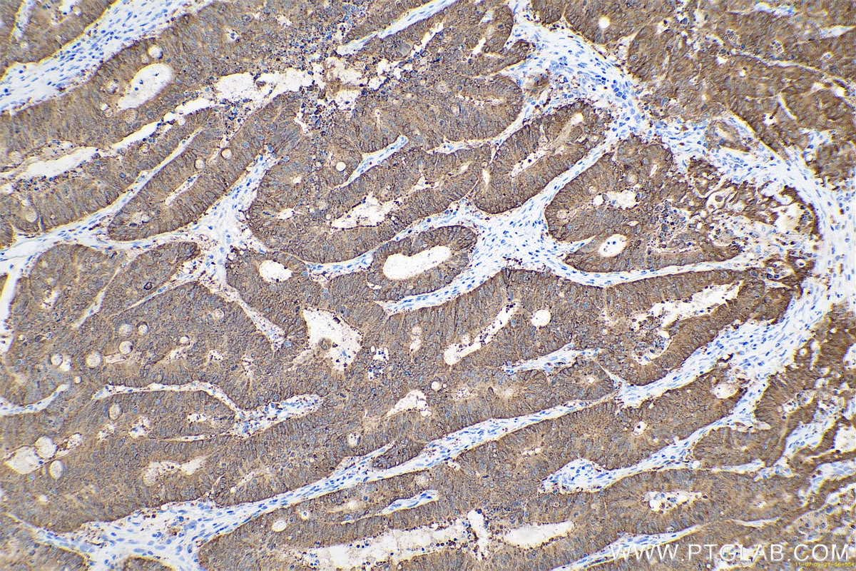 Immunohistochemical analysis of paraffin-embedded human colon cancer tissue slide using KHC0671 (LGALS4 IHC Kit).