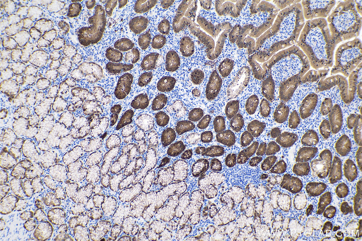Immunohistochemical analysis of paraffin-embedded human stomach cancer tissue slide using KHC0671 (LGALS4 IHC Kit).