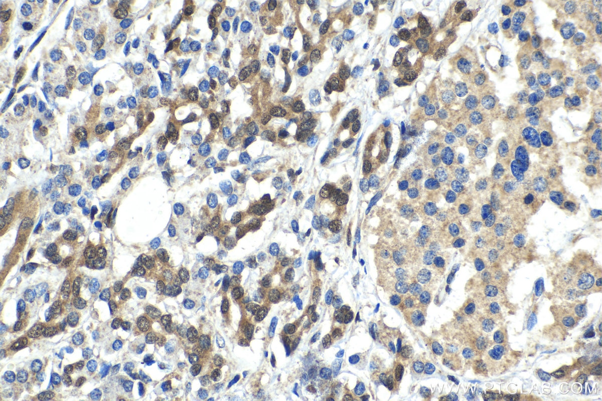 Immunohistochemical analysis of paraffin-embedded human pancreas cancer tissue slide using KHC1418 (LGALS9 IHC Kit).