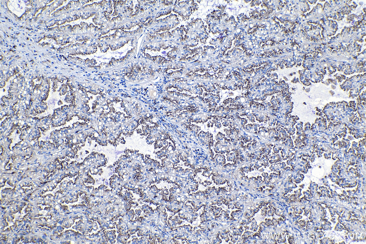 Immunohistochemical analysis of paraffin-embedded human lung cancer tissue slide using KHC1214 (LGMN IHC Kit).