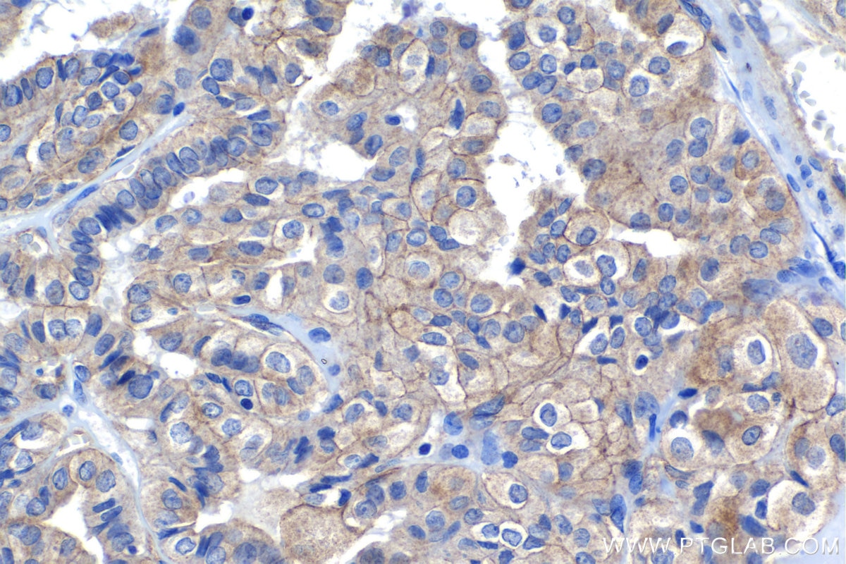 Immunohistochemical analysis of paraffin-embedded human thyroid cancer tissue slide using KHC1180 (LIMCH1 IHC Kit).