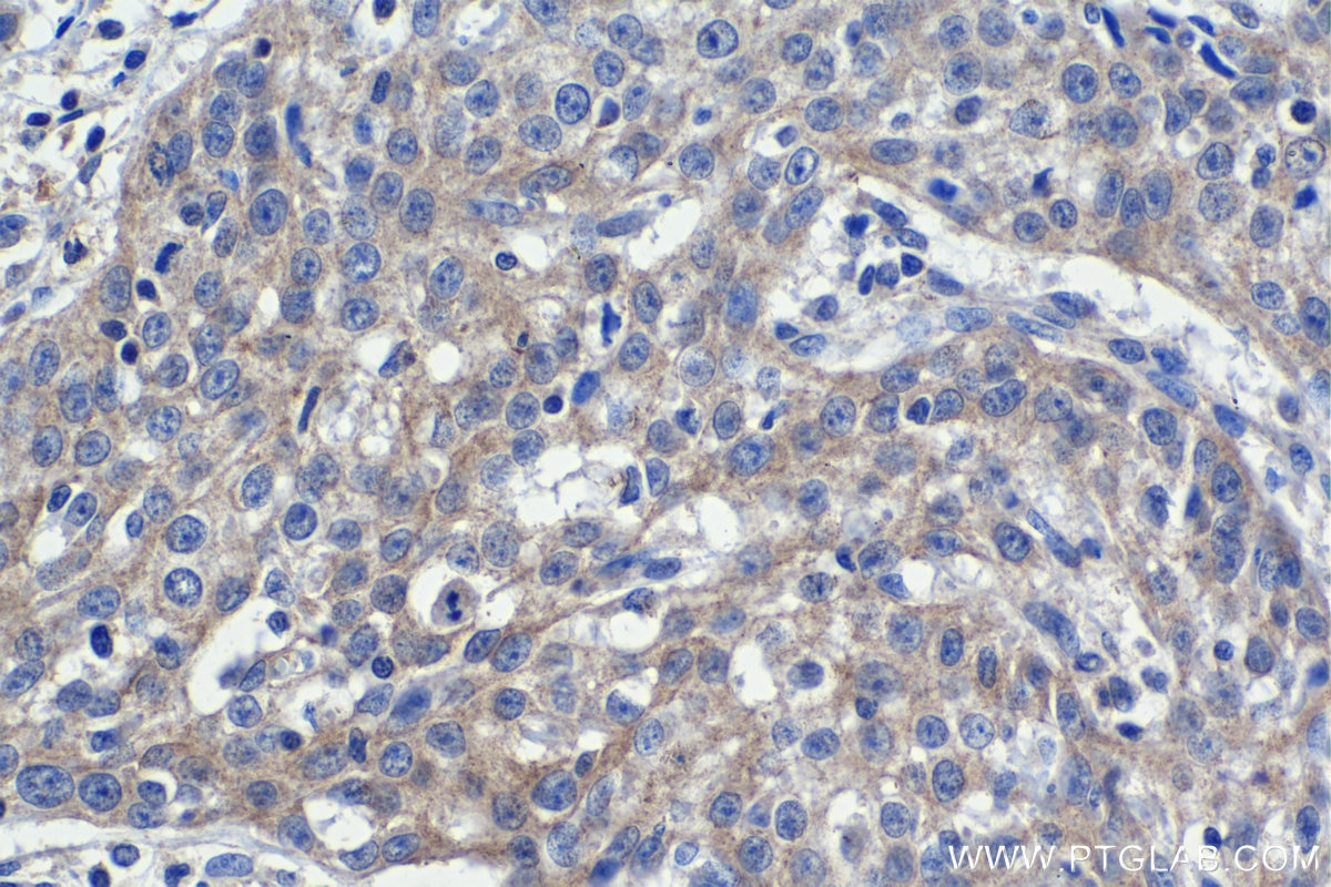 Immunohistochemical analysis of paraffin-embedded human cervical cancer tissue slide using KHC1180 (LIMCH1 IHC Kit).