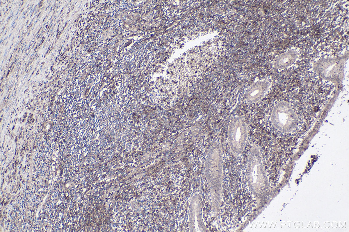 Immunohistochemical analysis of paraffin-embedded human appendicitis tissue slide using KHC1896 (LITAF IHC Kit).