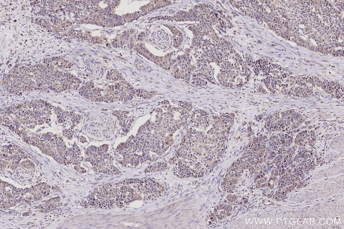 Immunohistochemical analysis of paraffin-embedded human stomach cancer tissue slide using KHC3116 (LMF2 IHC Kit). Immunohistochemical analysis of paraffin-embedded human stomach cancer tissue slide using KHC3116 (LMF2 IHC Kit).