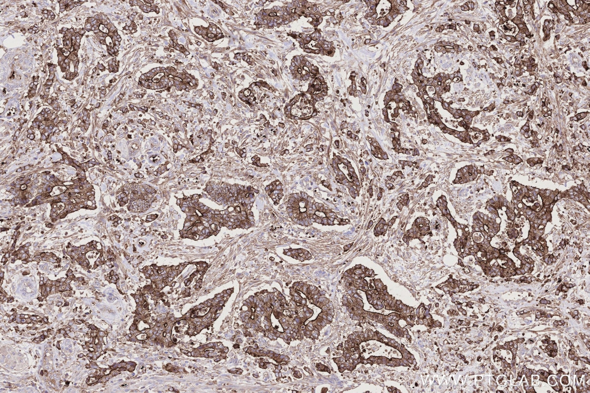 Immunohistochemical analysis of paraffin-embedded human rectal cancer tissue slide using KHC2738 (LMO7 IHC Kit).