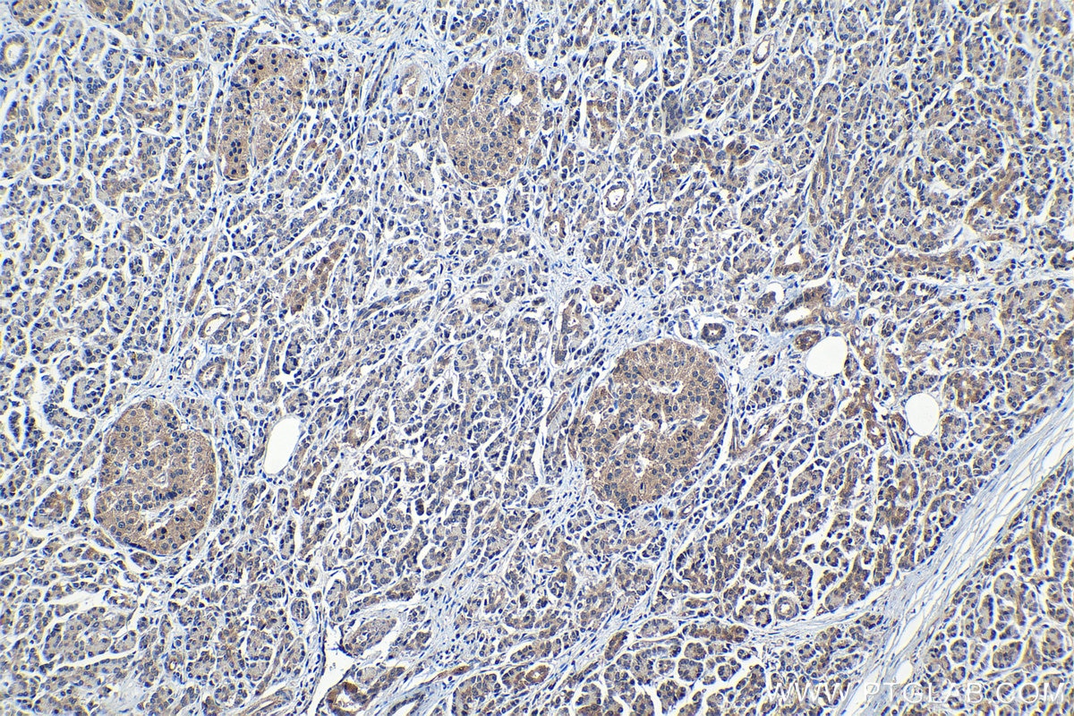 Immunohistochemical analysis of paraffin-embedded human pancreas cancer tissue slide using KHC1247 (LONP2 IHC Kit).