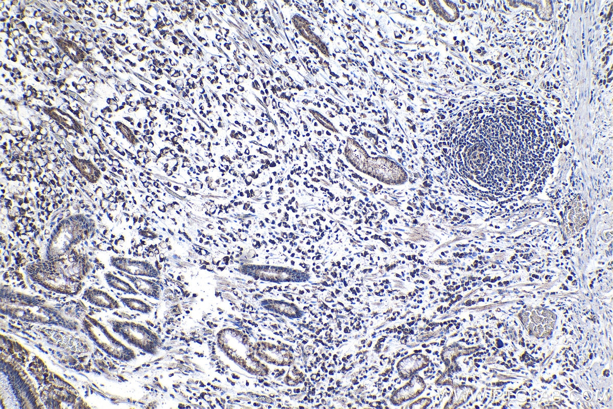 Immunohistochemical analysis of paraffin-embedded human stomach cancer tissue slide using KHC1247 (LONP2 IHC Kit).