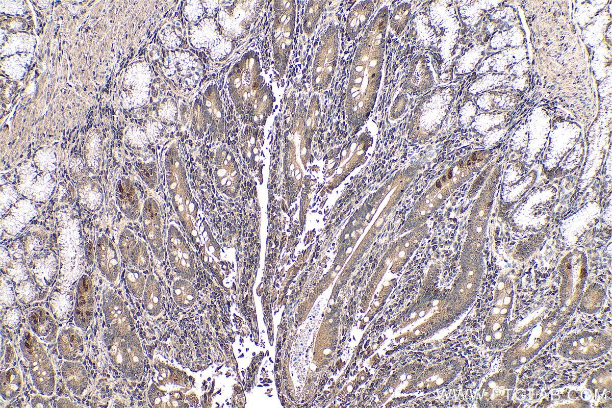 Immunohistochemical analysis of paraffin-embedded human stomach cancer tissue slide using KHC0630 (LOX IHC Kit).