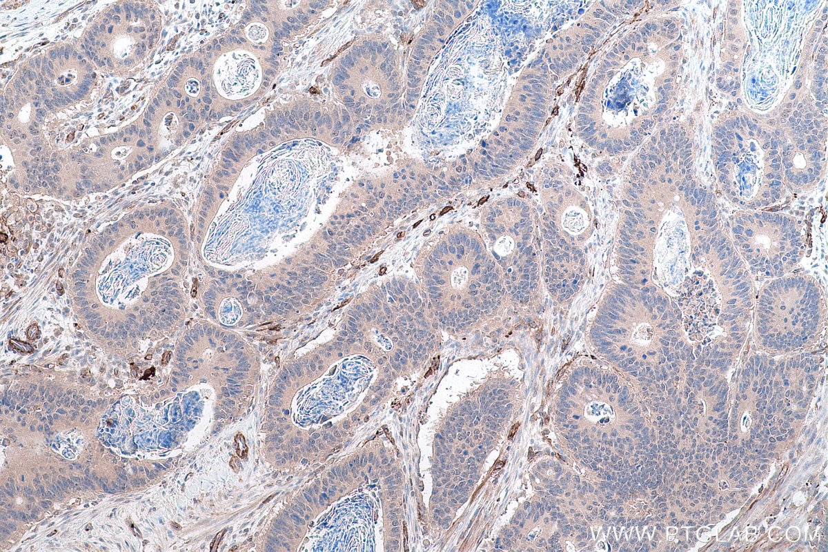 Immunohistochemical analysis of paraffin-embedded human colon cancer tissue slide using KHC0823 (LOXL2 IHC Kit).