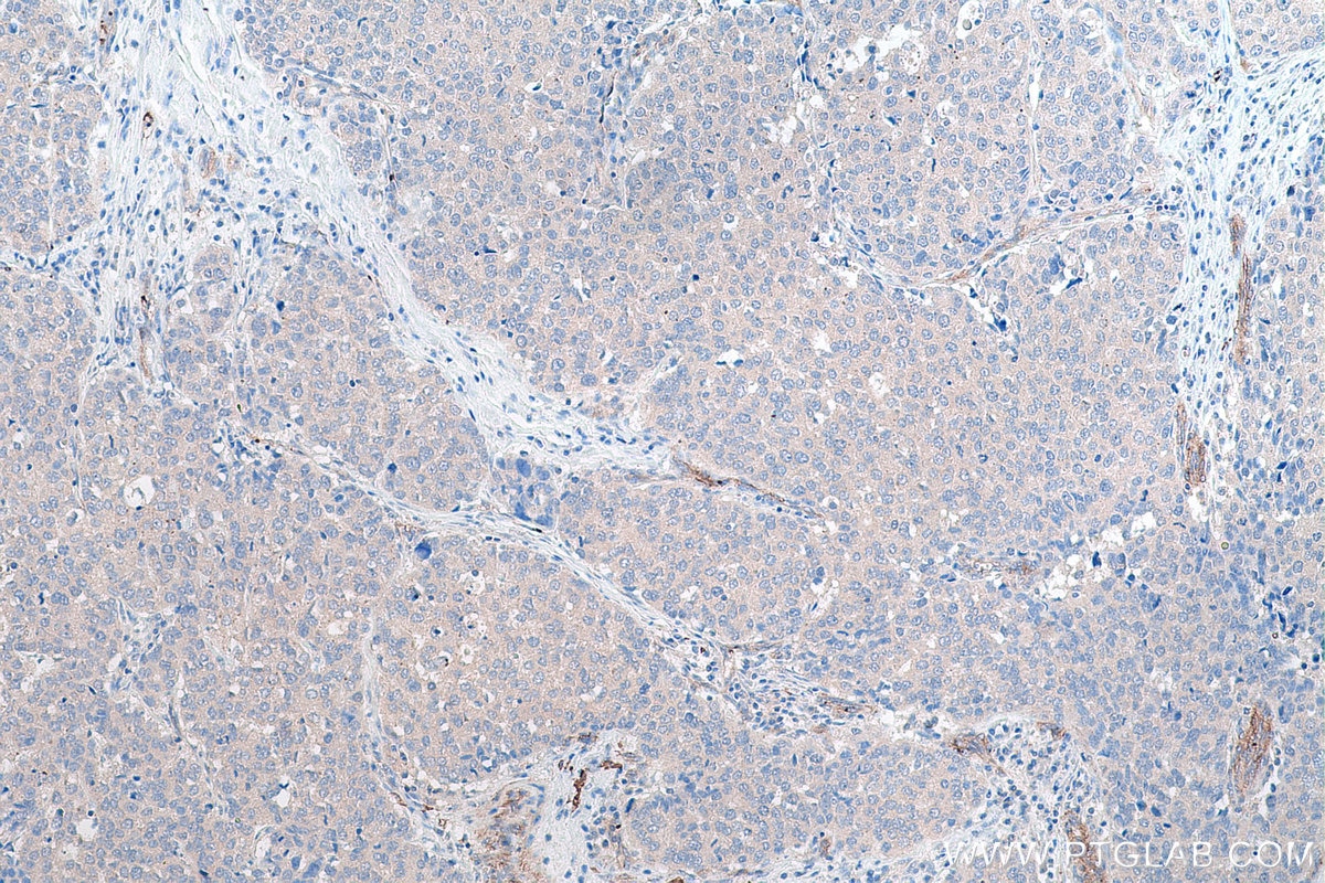 Immunohistochemical analysis of paraffin-embedded human stomach cancer tissue slide using KHC0823 (LOXL2 IHC Kit).
