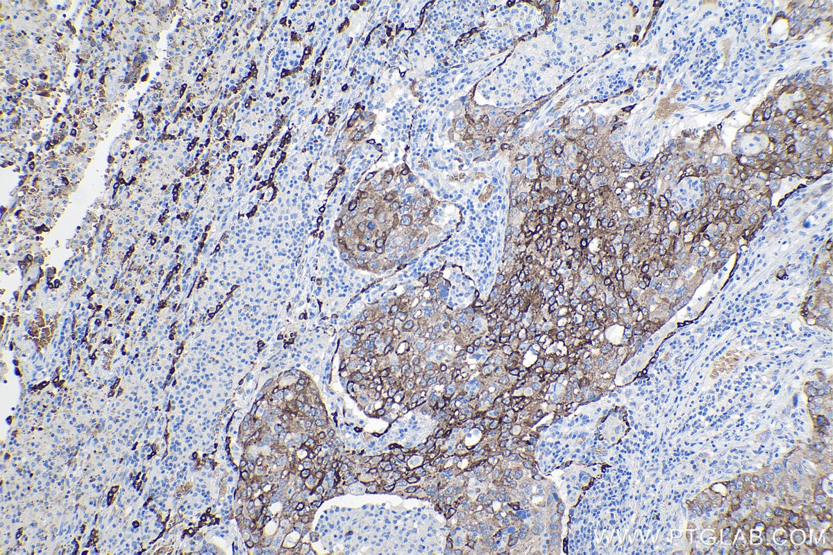 Immunohistochemical analysis of paraffin-embedded human lung cancer tissue slide using KHC1097 (LPCAT1 IHC Kit).