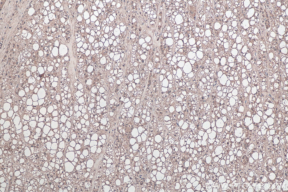 Immunohistochemical analysis of paraffin-embedded human liver cancer tissue slide using KHC0302 (LPIN1 IHC Kit).