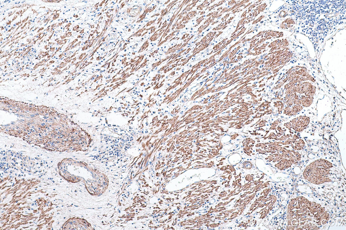 Immunohistochemical analysis of paraffin-embedded human colon cancer tissue slide using KHC0675 (LPP IHC Kit).